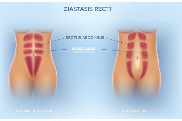What Non-Surgical Options Are Available for Diastasis Recti Ashbourne?