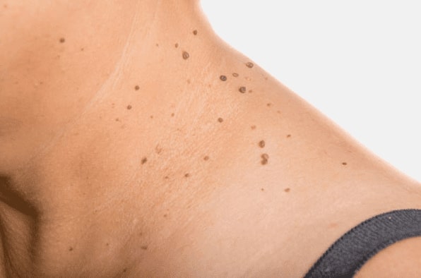 Are you looking for easy skin tag removal Ashbourne - then contact Spire today!