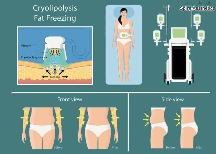 Image of diet and fat freezing combined for best results for Spire Aesthetics Ashbourne