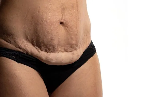 Image of womans stomach after weight loss injections Ashbourne showing saggy skin