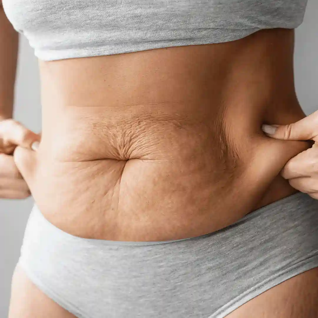 Is It Normal to Have Loose Skin After Pregnancy Ashbourne?